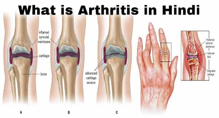 arthritis in hindi